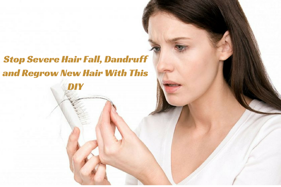 Stop Severe Hair Fall, Dandruff and Regrow New Hair With This DIY - Beauty and Blush Stop Severe Hair Fall, Dandruff and Regrow New Hair With This DIY - Beauty and Blush