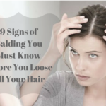 9 Signs of Balding You Must Know Before You Loose All Your Hair