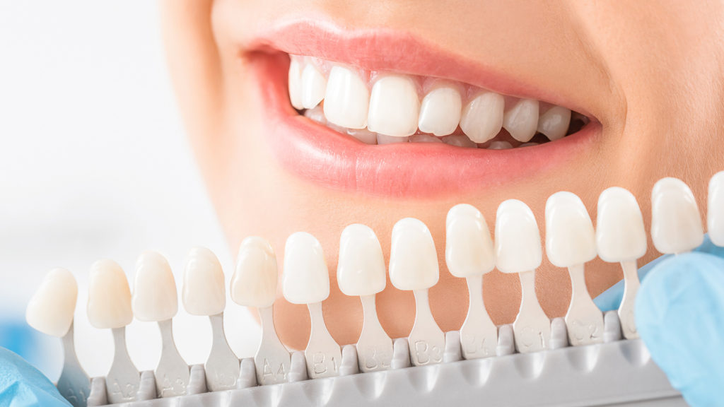 Whitening Options For Different Oral Situations
