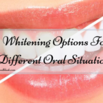 Whitening Options For Different Oral Situations
