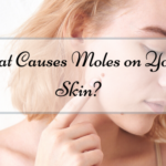 What Causes Moles on Your Skin?