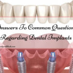 Answers To Common Questions Regarding Dental Implants