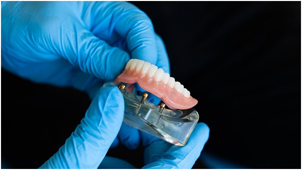 Answers To Common Questions Regarding Dental Implants