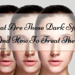 What Are Those Dark Spots? And How To Treat Them