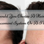 Should You Choose A Hair Replacement System Or A SMP