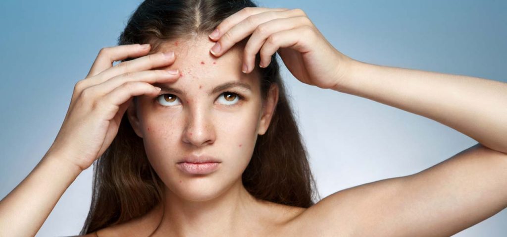 how-to-get-rid-of-sudden-breakouts