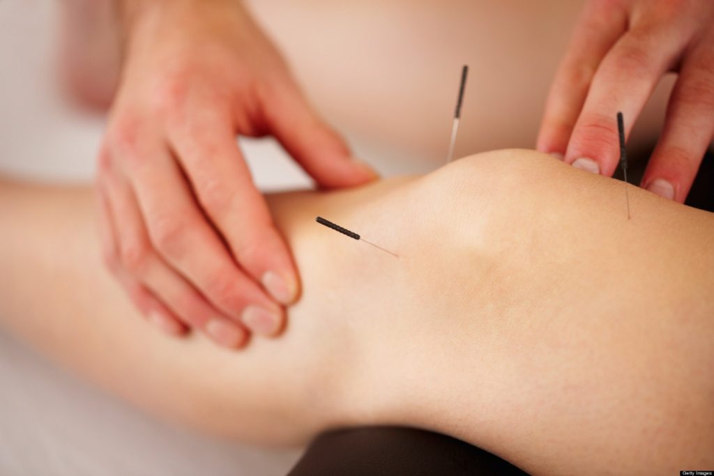 6 Ways Acupuncture Can Help You Achieve Your Fitness Goals