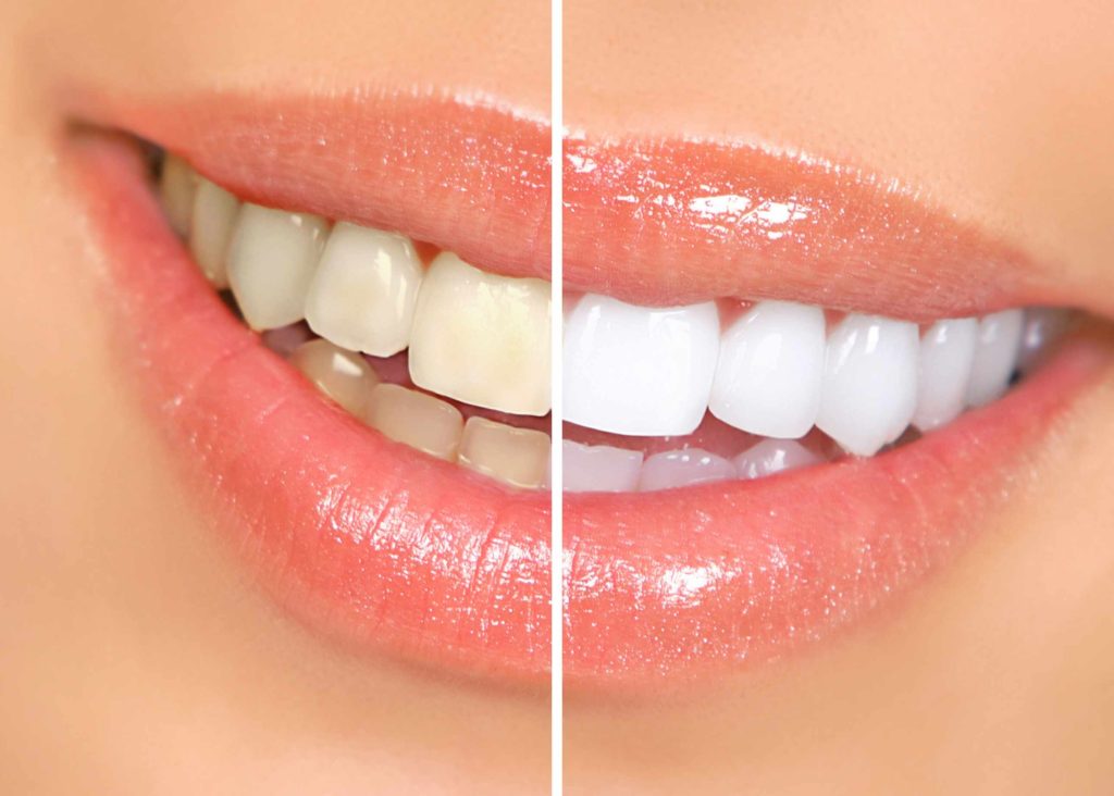 Whitening Options For Different Oral Situations