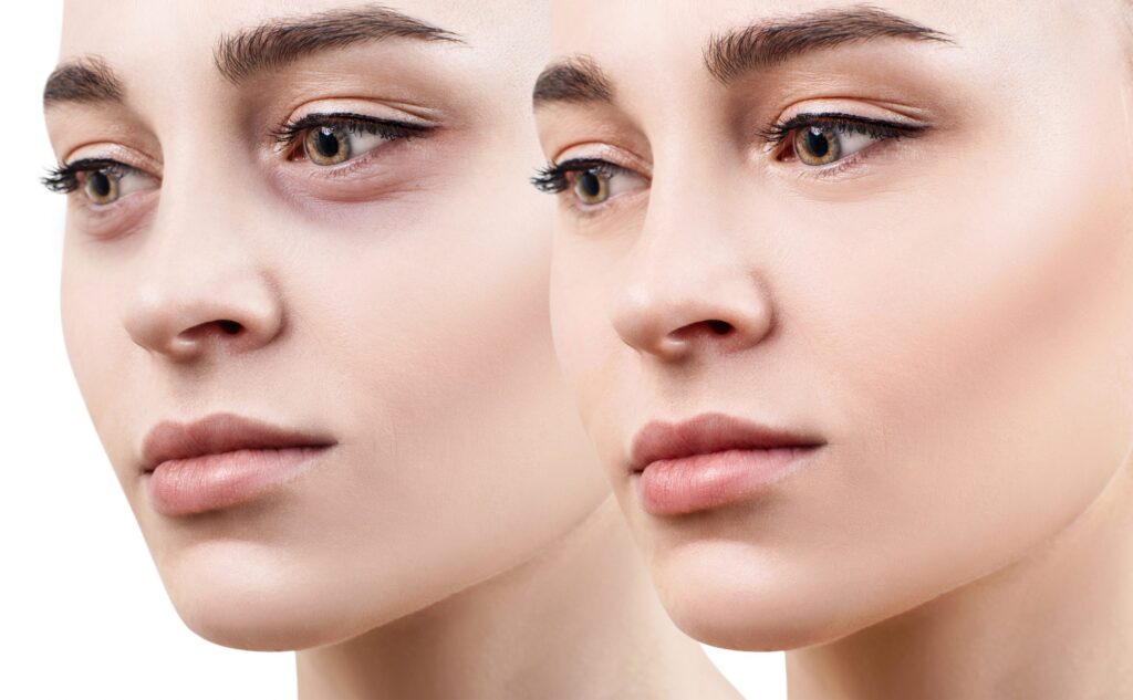 The Ultimate Guide To Banishing Dark Circles Through Aesthetic Treatments